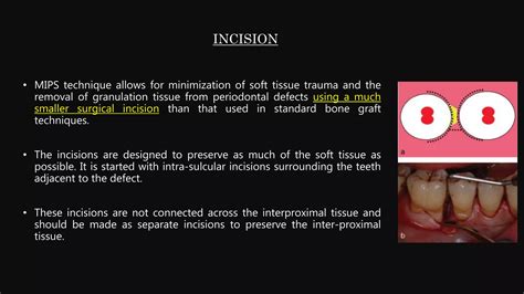 Minimally Invasive Periodontal Surgery Ppt