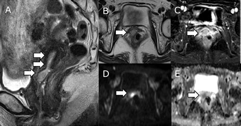 Figure 3 From High Grade Endometrial Stromal Sarcoma With Ywhae Nutm2b