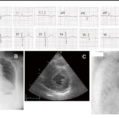 A Electrocardiogram B Chest X Ray C Echocardiography And D