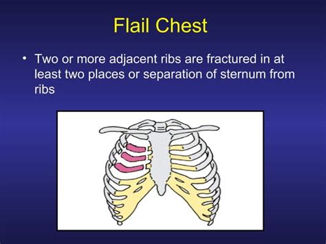 Treating Penetrating Chest Trauma PPT