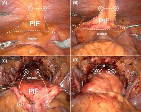 Impact Of Peritoneal Interposition Flap On Patients Undergoing Robot