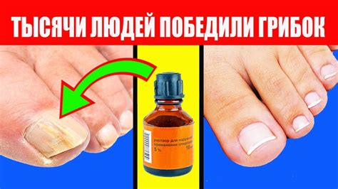 Лак от грибка ногтей: ТОП-5 недорогих и эффективных противогрибковых лаков