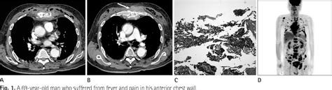 Figure 1 From Inflammatory Metastatic Carcinoma Of Sternum Mimicking