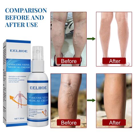 Jual Herbal Varicose Veins Treatment Spray Ubat Vena Varikos Phlebitis