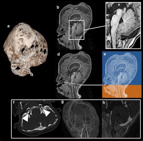 Radiological Findings In Crouzon Syndrome A Related To The Download Scientific Diagram