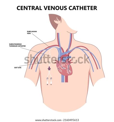 Central Venous Catheter