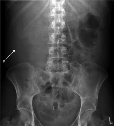 Abdominal Radiograph Demonstrating A The Outline Of A Large Soft Download Scientific Diagram