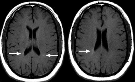 Problems with assessing new lesions on MRI – Prof G's MS Blog Archive