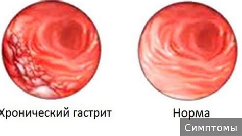 Хронический гастрит. Как лечить хронический гастрит. - YouTube