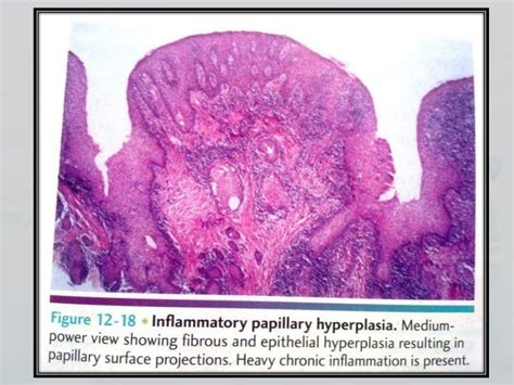 Inflammatory Pappilary Hyperplasia And Ranula