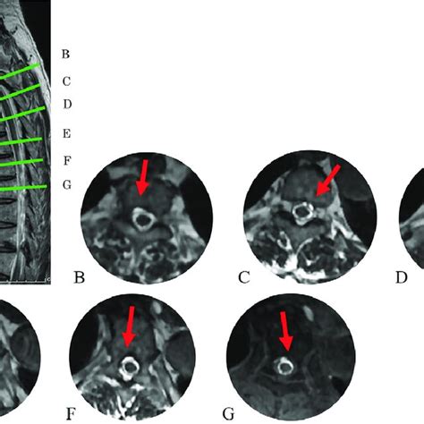 Head T2* MRI shows hemosiderin deposition on the superior surface of ...