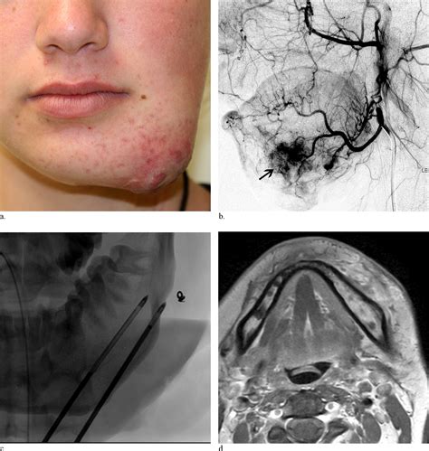 Treatment Of Residual Facial Arteriovenous Malformations After