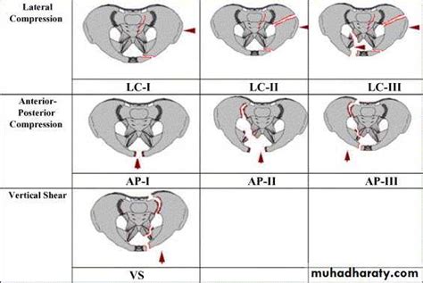 Pelvic Fracture Classification Radiology