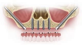 Zygoma Dental Implants in Brooklyn, NY | Smile by Design