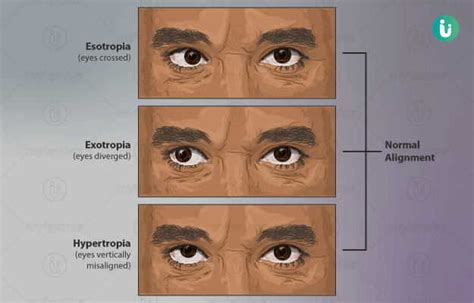 Cross-Eyes: symptoms, causes, treatment, medicine, prevention, diagnosis