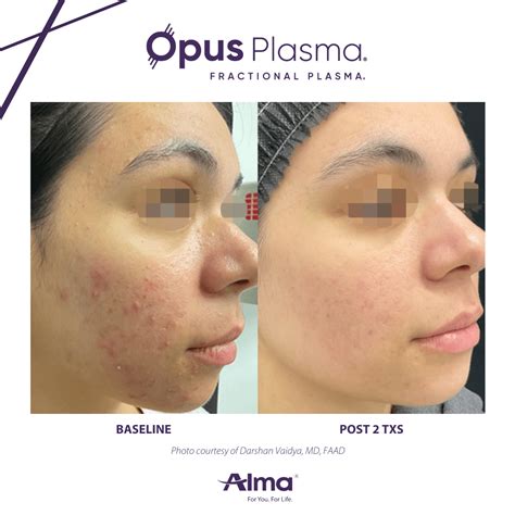 Opus Plasma Treatment Calgary DermNurse Medical Aesthetics