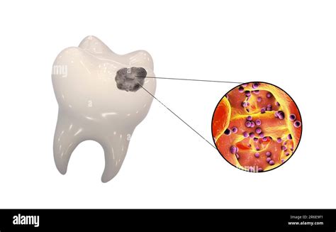 Caries Dental Ilustraciones Informáticas De Un Diente Con Cavidad Y Vista De Cerca De Las