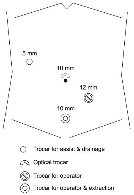 Trocar Sites For Laparoscopic Resection Of An Appendiceal Mucocele