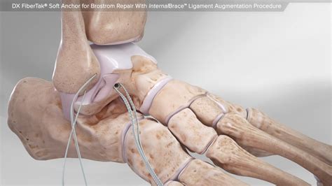 Arthrex Dx Fibertak® Soft Anchor For Brostrom Repair With Internalbrace™ Ligament Augmentation