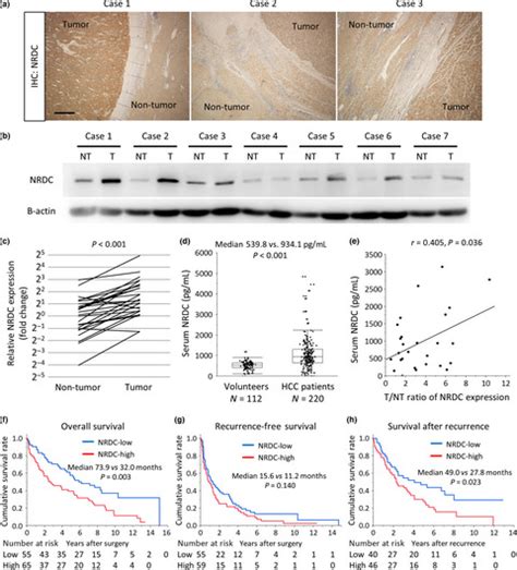 Nardilysin Promotes Hepatocellular Carcinoma Through Activation Of