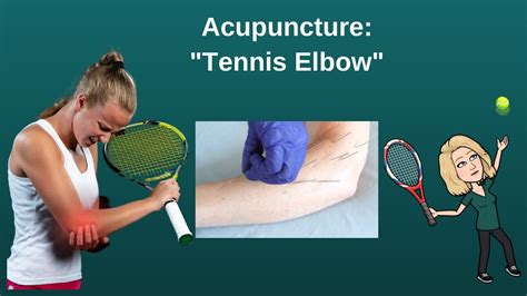 Tennis Elbow Lateral Epicondylitis Self Piercing Acupuncture Demonstration Youtube