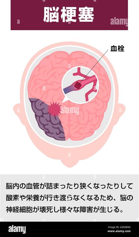 Illustrazione Dei Tipi Di Ictus Cerebrale Umano Infarto Cerebrale