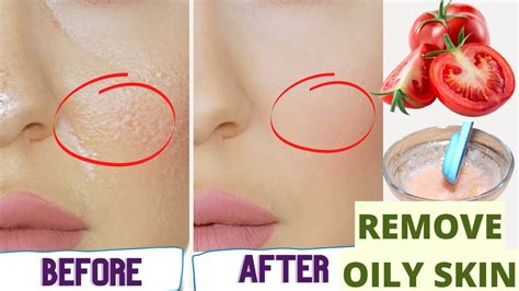 How To Get Rid Of Oily Skin Permanently Home Remedies For Oily Skin