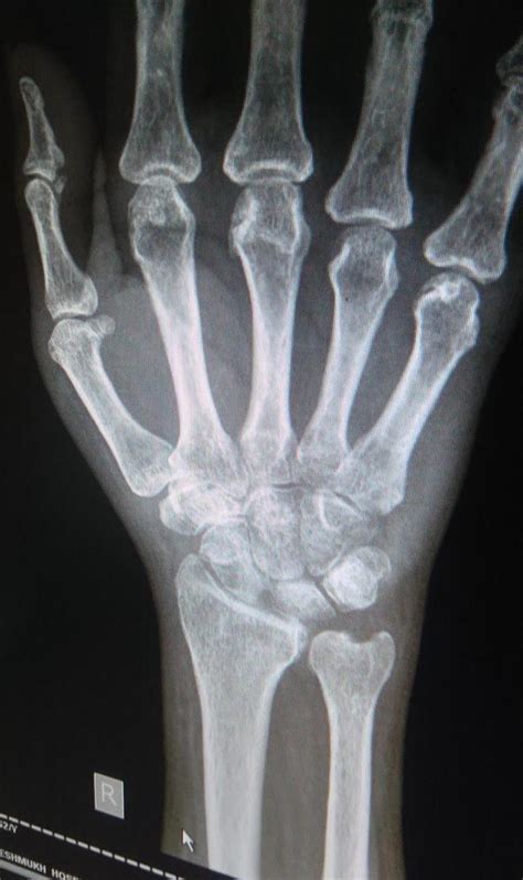 Wrist Arthritis - Hand - Orthobullets