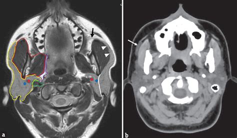 Parotid Gland Tumor Mri