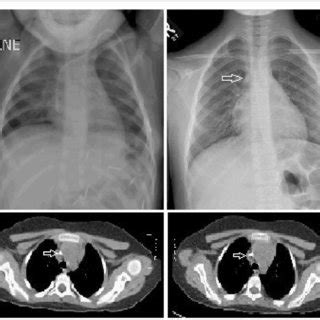 Follow Up Chest X Ray And Chest Ct Scan After Years Of Catheter