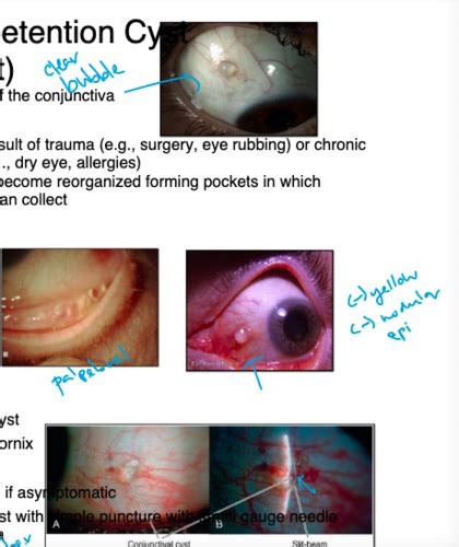 Conjunctiva Benign Lesions Flashcards Quizlet