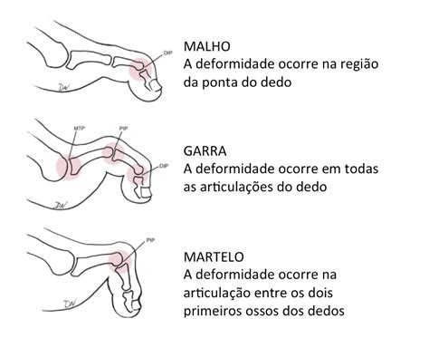 Dedos Em Garra Como Surgem E Como Corrigir Dr Rodrigo Macedo