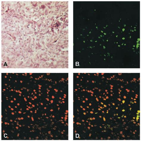 Histology Of Igrov Tumors In Scid Mice And Egfp Expression By