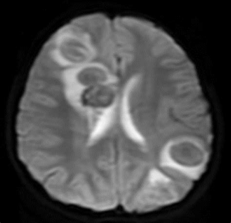 A Brain Populated With Space Occupying Lesions Identifying The Culprit