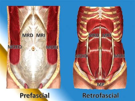 Anatomía De La Pared Abdominal Sin Diástasis Abdominal