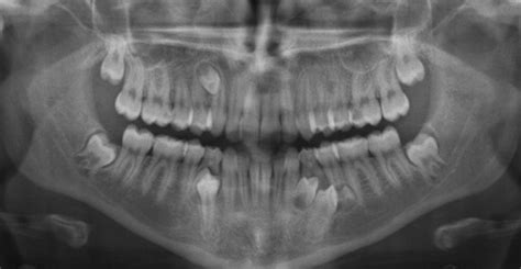 Hyperdontia X Ray