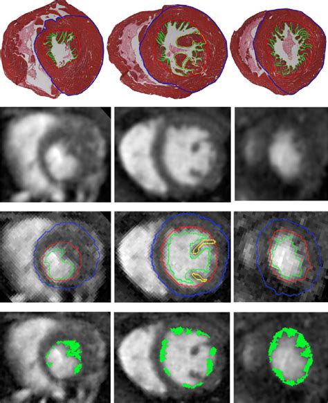 Example Of Left Ventricular Whole Heart Cmr Segmentation And