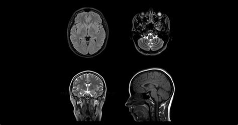 Mri Of The Brain In Different Projections Horizontal Vertical