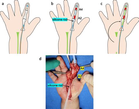 Flexor Digitorum Profundus Tendon