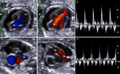 Color And Pulsed Wave Doppler Showing A Typical To And Fro Flow Across Download Scientific