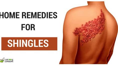 Home Remedies For Shingles