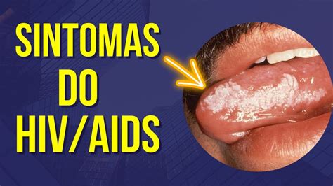 SINTOMAS DO HIV AIDS YouTube