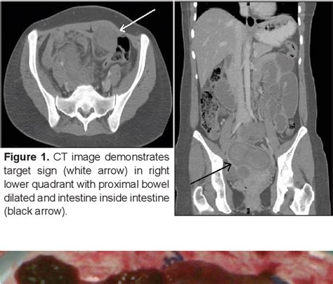 Figure 1 From Ileoileal Intussusception Caused By Ileal Lymphangioma In