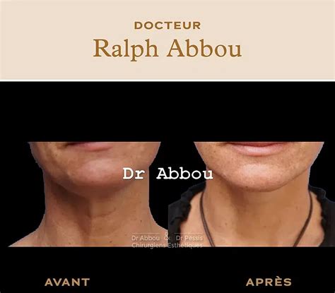 Lifting Du Cou Sans Chirurgie Paris Dr Abbou Et Dr Pessis