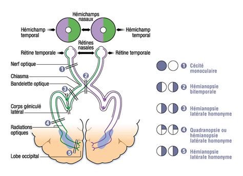 Anomalies du champ visuel lésion des voies visuelles Le livre de