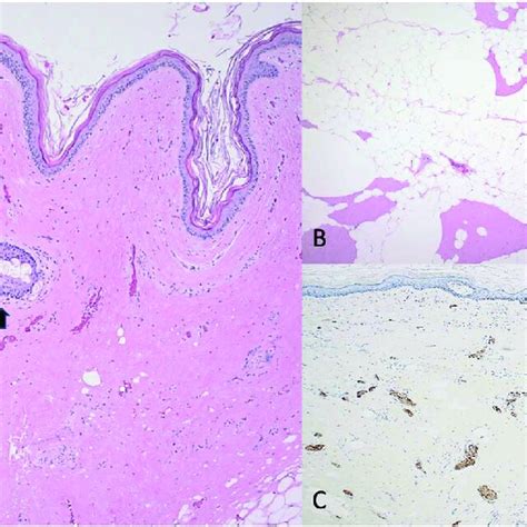 A Dermoid Cyst H The Cystic Structure Is Lined By Squamous