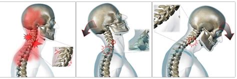 Whiplash Injury On Nerves