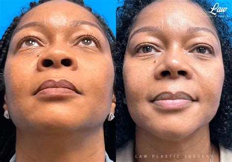 Black Rhinoplasty Before And After