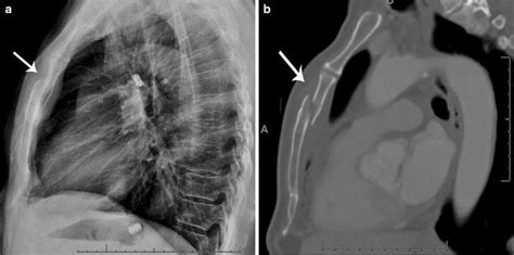 Sternum Fracture X Rays