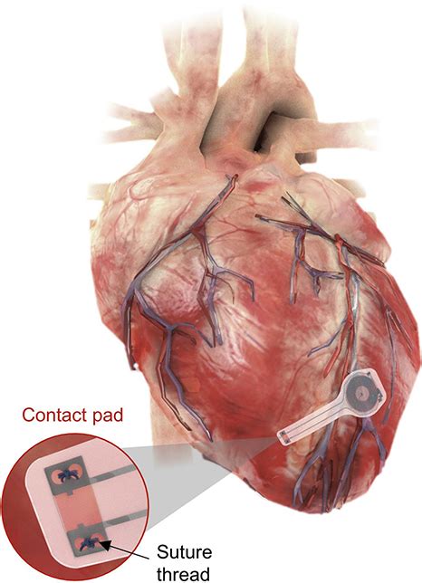 Battery Free Wireless Pacemaker Dissolves Post Treatment Health Blog